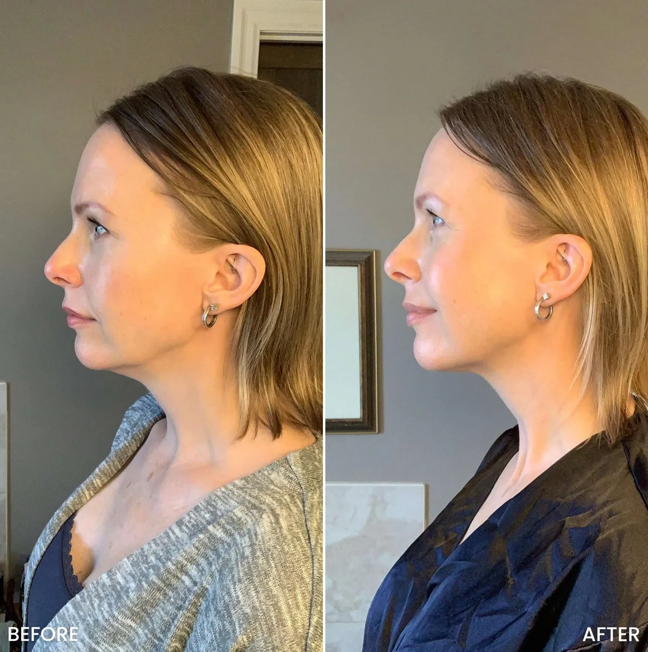 Tite FaceWare™️ UltraFirm Cellulite Eraser