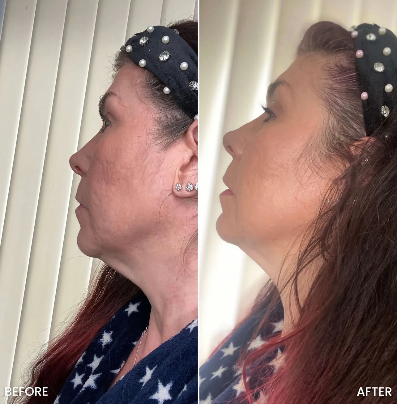 Tite FaceWare™️ UltraFirm Cellulite Eraser