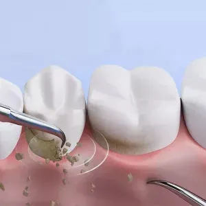 Ultrasonic scaler