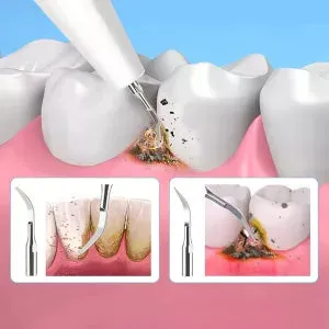 Ultrasonic scaler